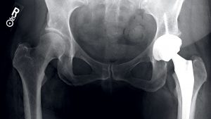 Is Washingtonians’ Addiction to Exercise Ruining Our Joints?