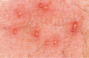 A Mysterious New Insect Is Feasting on DC-Area People and Making Them Think They Have Bed Bugs