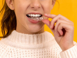 What I Wish I Had Known Before Getting Invisalign